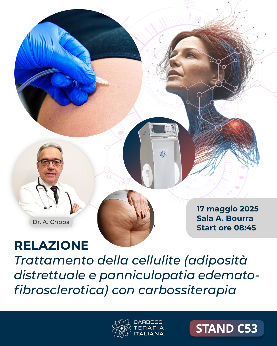📣 SAVE THE DATE – SIME 2025📍 Roma, 17 maggio – Sala A. Bourra, ore 08:45Siamo orgogliosi di annunciare la partecipazione del Dr. Angelo Crippa, opinion leader di Carbossiterapia Italiana, al SIME 2025 con una relazione scientifica di grande rilevanza per la medicina estetica:🔬 “Trattamento della cellulite (adiposità distrettuale e panniculopatia edematofibrosclerotica) con carbossiterapia”Un appuntamento imperdibile per tutti i professionisti che desiderano approfondire le potenzialità cliniche della carbossiterapia nel trattamento della cellulite, con focus su evidenze, protocolli e risultati concreti.🗓️ Quando: 17 maggio 2025📌 Dove: Sala A. Bourra – Start ore 08:45👉 Vi aspettiamo numerosi per condividere know-how, innovazione e confronto clinico!#SIME2025 #CarbossiterapiaItaliana #DrAngeloCrippa #MedicinaEstetica #Cellulite #Carbossiterapia #FormazioneMedica @simecongress @dottor_angelocrippa