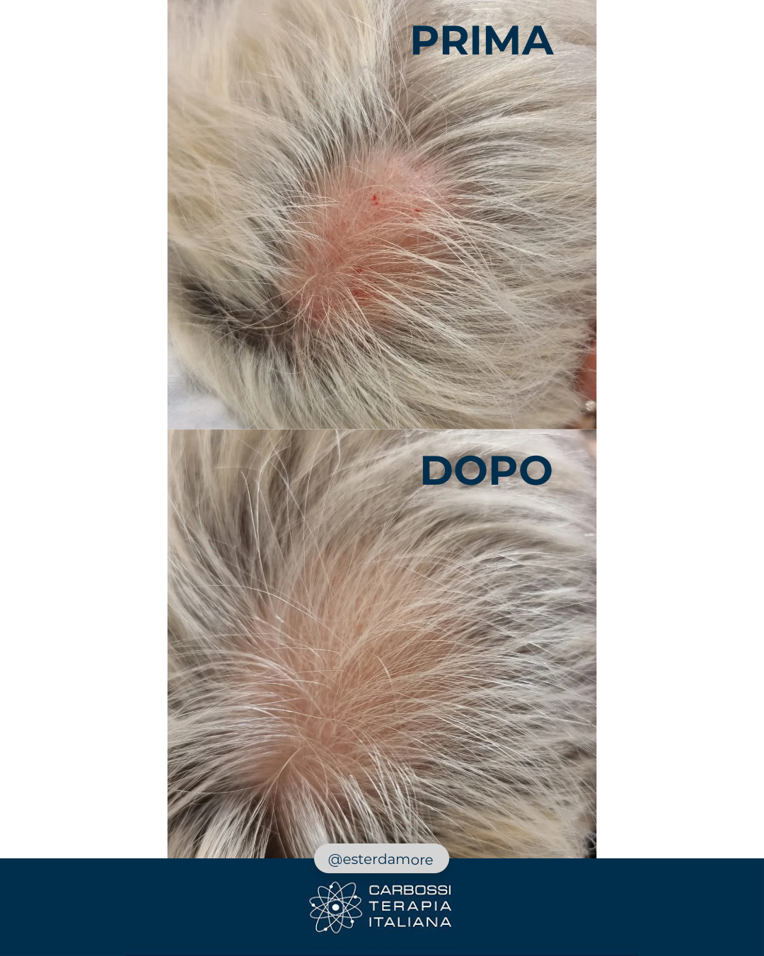 🔬✨ RISULTATI STRAORDINARI CON LE TERAPIE COMBINATE! ✨🔬Un enorme grazie alla Dr.ssa Ester D’Amore per aver condiviso questo incredibile risultato ottenuto grazie alla combinazione della nostra Carbossiterapia CDT LIGHT con Cellbooster Hair! 👏In questa paziente, affetta da una chiazza alopecica importante, è stata effettuata una prima seduta di Carbossiterapia associata a iniezioni di Cellbooster Hair, un potente rivitalizzante del follicolo pilifero. Il risultato? Già dopo una sola seduta si nota un evidente miglioramento! La paziente proseguirà con 3-4 sedute per una risoluzione ottimale del problema.🔝 Questo è solo un esempio dei fantastici risultati che si possono ottenere combinando la Carbossiterapia con altri trattamenti mirati!Se sei un medico e non hai ancora CDT LIGHT nel tuo studio, contattaci per scoprire di più e offrire ai tuoi pazienti trattamenti ancora più efficaci! 📩✨#Carbossiterapia #CDTLIGHT #TerapieCombinate #CellboosterHair #RicrescitaCapelli #MedicinaEstetica #RisultatiVisibili