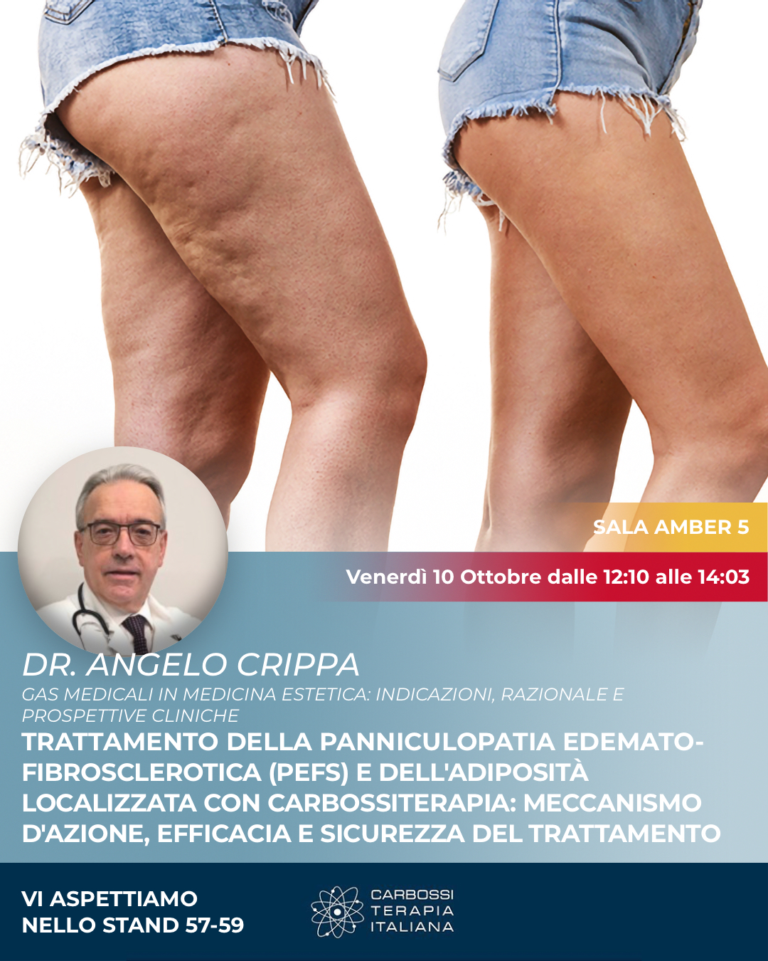 ✨ CARBOSSITERAPIA ITALIANA @ AGORÀ 2025 ✨
Siamo lieti di invitarvi alla relazione del Dr. Angelo Crippa, dedicata all’utilizzo dei gas medicali in medicina estetica e in particolare al
trattamento della Panniculopatia Edemato-Fibrosclerotica (PEFS) e dell’adiposità localizzata con carbossiterapia.
📍 Sala Amber 5
🗓️ Venerdì 10 Ottobre, dalle 12:10 alle 14:03
📌 Stand 57-59
Un approfondimento sul meccanismo d’azione, efficacia e sicurezza di una metodica che continua a confermarsi tra le più efficaci per migliorare la microcircolazione, ridurre la cellulite e ridefinire la silhouette in modo naturale e sicuro.
👉 Vi aspettiamo per scoprire tutte le novità firmate Carbossiterapia Italiana.
#Carbossiterapia #Agorà2025 #MedicinaEstetica #DottCrippa #Cellulite #AdipositàLocalizzata #CDTLight #Rigenerazione #Innovazione #TrattamentoCorpo