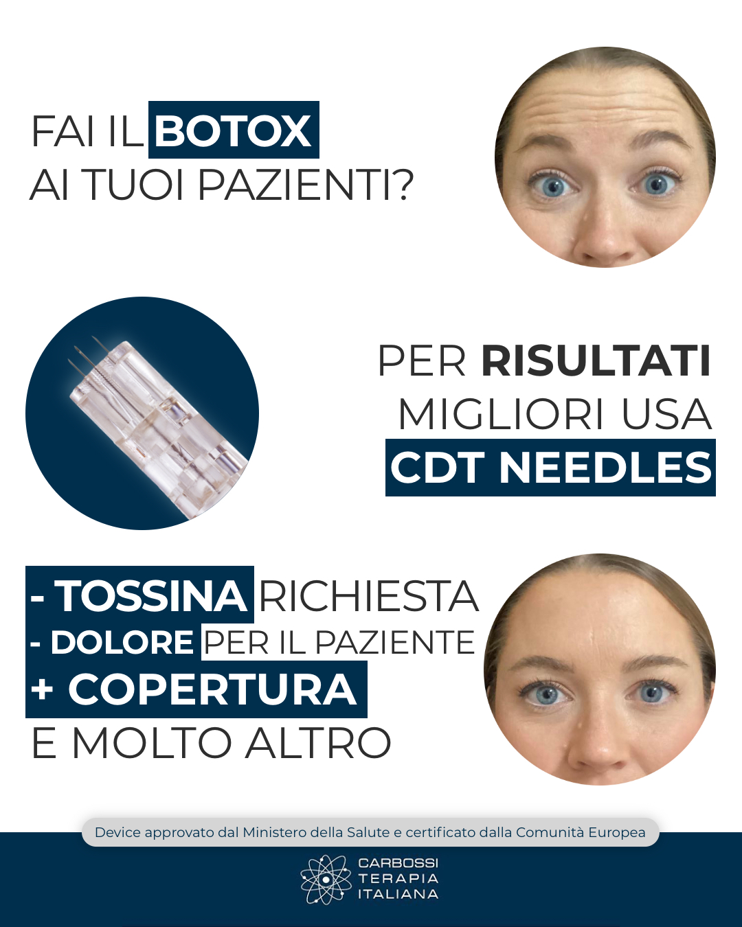 Grazie a #CDTNeedle è possibile utilizzare fino all’85% in meno di #tossinabotulinica per ottenere LO STESSO RISULTATO, risultando tra l’altro in meno fastidi per il paziente e una seduta più rapida!Particolarmente interessante per esempio nella cura della #iperidrosi, in cui è richiesto un numero maggiore di inienzioni!Questo è solo uno dei tantissimi campi di applicazione dei CDT Needle: contattaci per maggiori informazioni!#CarbossiterapiaItaliana #Botox