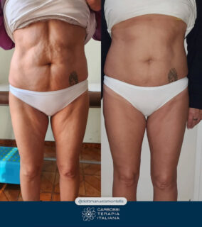 Un altro eccellente lavoro svolto dalla nostra cara @dottemanuelamontella, che grazie all’utilizzo della nostra #Carbossiterapia (e al supporto di alimentazione e movimento) è riuscita in 5 sedute a donare alla sua paziente un risultato eccellente! 🦵🍊

Visitate il suo profilo per poter ammirare altri suoi lavori 👉 https://www.facebook.com/dottemanuelamontella

Non avete ancora introdotto la Carbossiterapia nel vostro studio? Contattateci: vi si aprirà un mondo di possibilità per la bellezza e la salute dei vostri pazienti!
#CarbossiterapiaItaliana
*
*
*
#provacostume #dottssaemanuelamontella #belle #gambe #avellino #medicina #medicinaestetica