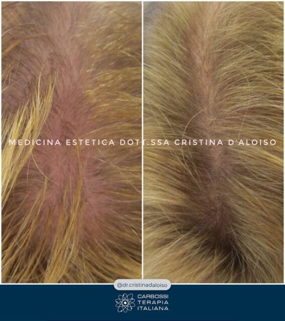 👏 Un ringraziamento e sincere congratulazioni alla @dr.cristinadaloiso per l’ottimo lavoro svolto nel ridurre i segni dell’alopecia nella sua paziente. 🌿✨La carbossiterapia rappresenta oggi uno dei trattamenti più efficaci per la stimolazione del cuoio capelluto: l’anidride carbonica medicale migliora la microcircolazione, aumenta l’ossigenazione dei tessuti e riattiva i follicoli dormienti, favorendo una crescita capillare più sana e vigorosa. 💨💆‍♀️Grazie a dispositivi come CDT Light, il trattamento diventa preciso, sicuro e confortevole, con risultati visibili in poche sedute. 💎#CDTLight #CarbossiterapiaItaliana #Alopecia #HairRegrowth #Tricologia #MedicinaEstetica #Rigenerazione #DrCristinaDaloiso #InnovazioneMedica #MadeInItaly