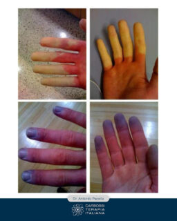 Vi capita di avere mani e piedi freddi in inverno e gonfi in estate? 🥶🥵
Spesso la causa non è un “problema di circolazione generale”, ma una ridotta funzionalità dei piccoli vasi sottocutanei e una minore ossigenazione dei tessuti.

👉 In questi casi, la carbossiterapia può essere una grande alleata: l’anidride carbonica medicale migliora il microcircolo, favorisce lo scambio di ossigeno e aiuta tessuti e capillari a lavorare meglio.

Un grazie speciale al Dr. Antonio Pacella 🙏
Non solo per aver scelto CDT Light di Carbossiterapia Italiana nella sua pratica clinica, ma anche per i suoi continui post informativi sulla carbossiterapia e per i risultati concreti che condivide ogni giorno con i pazienti e i colleghi.

Diffondere cultura medica significa anche questo: spiegare in modo semplice come un trattamento mirato può migliorare la qualità di vita delle persone. 💬✨

#Carbossiterapia #CarbossiterapiaItaliana #CDTLight #Microcircolo #ManiEPiediFreddi #MedicinaEstetica #AntonioPacella