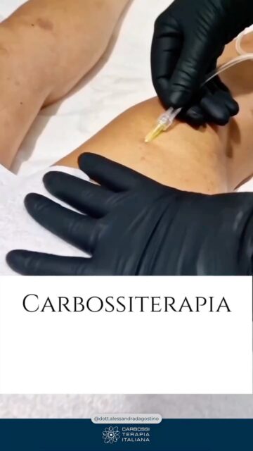 Ringraziamo la @dott.alessandradagostino per aver scelto la nostra #Carbossiterapia e per il suo ottimo lavoro di informazione scientifica al riguardo che sta facendo sia nei social che con il pubblico in studio.📍 Salerno, Corso Vittorio Emanuele, 143☎️338 243 7094#CarbossiterapiaItaliana #CDTLIGHT #carbossiterapia #medicinaesteticasalerno #filler