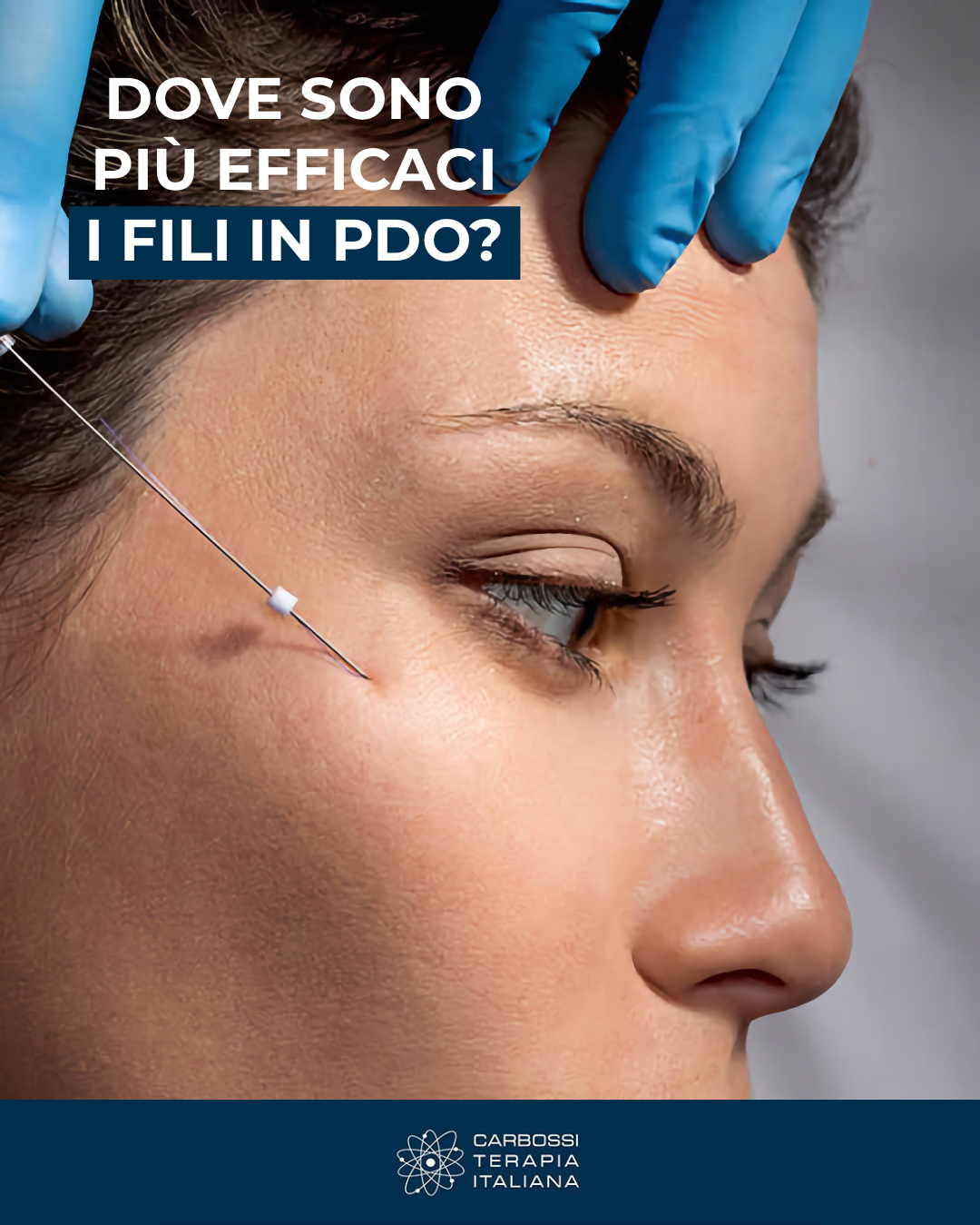 Con il tempo la pelle perde tono e definizione: i fili PDO sono una soluzione mini-invasiva ideale per sollevare, sostenere e migliorare la compattezza della pelle.

✨ Dove sono più efficaci?
✅ Linea mandibolare: più definizione, meno rilassamento e “jowls”
✅ Guance: sostegno e riposizionamento dei volumi, effetto lift naturale
✅ Collo: maggiore tonicità e pelle più liscia
✅ Sopracciglia: sguardo più aperto e fresco con un lifting delicato
✅ Rughe sottili perioculari: miglioramento della texture e della qualità cutanea

Vuoi approfondire? Scopri di più sulla linea fili in PDF Shaping Up ed Elevance di Carbossiterapia Italiana.

#FiliPDO #ThreadLift #MedicinaEstetica #Jawline #Guance #Collo #CarbossiterapiaItaliana #ShapingUp #Elevance #SkinTightening #AntiAge