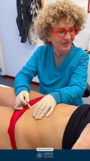 Ringraziamo lo @studio.turatello per aver scelto la nostra #Carbossiterapia e per il suo ottimo lavoro di informazione scientifica al riguardo che sta facendo sia nei social che con il pubblico in studio.#CarbossiterapiaItaliana #CDTLIGHT #carbossiterapia #filler