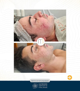Un ringraziamento speciale a @clinicamanuelarebelo per aver scelto la nostra carbossiterapia CDT LIGHT e per l’eccellente informazione scientifica condivisa nei suoi post! 🙌

La lotta contro l’acne non riguarda solo l’aspetto estetico, ma anche il recupero della sicurezza in sé stessi e della libertà sociale.

Come ricorda la Clinica Manuela Rebelo, ogni pelle è unica e merita un approccio personalizzato, pensato per offrire risultati reali e duraturi. Con i giusti trattamenti, è possibile ritrovare una pelle più sana e soprattutto una nuova autostima.

Grazie per diffondere consapevolezza e per il vostro impegno nel fornire soluzioni efficaci ai pazienti!

#carbossiterapia #carbossiterapiaitaliana #acne #curaacne #medicinaestetica #clinicamanuelarebelo #pellepulita #trattamentipersonalizzati