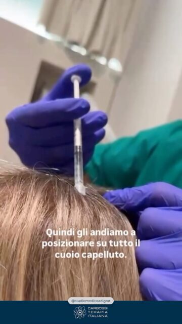 Un sentito ringraziamento a Studio Medico Adigrat di Milano per aver integrato in modo eccellente due tecnologie altamente innovative: Carbossiterapia CDT Light ed Esosomi Dermagenetic.Una sinergia avanzata che lavora in profondità per riattivare i follicoli, migliorare l’ossigenazione del cuoio capelluto, rinforzare i capelli e contrastare efficacemente la caduta, favorendo una crescita più sana, forte e duratura.L’unione tra stimolazione vascolare e rigenerazione cellulare rappresenta oggi uno degli approcci più evoluti nella medicina rigenerativa applicata ai capelli.#CarbossiterapiaItaliana#studiomedicoadigrat #medicinaesteticamilano #esosomi #ricrescitacapelli