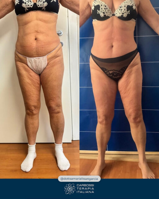 Un risultato visibile già dopo la prima seduta non è mai casuale.È il frutto di un protocollo costruito con competenza, visione e attenzione al dettaglio.Un sentito grazie alla dr.ssa @dottsamarialissetgarcia per aver scelto la Carbossiterapia CDT LIGHT per il suo studio e per l’eccellente lavoro svolto sulla sua paziente.In questo caso, l’approccio combinato con Lipocel, LPG Endermologie e Carbossiterapia ha avuto un obiettivo chiaro: lavorare in profondità sulla qualità del tessuto, non fermarsi all’aspetto superficiale.Agire su microcircolo, tono e struttura cutanea significa permettere al corpo di rispondere in modo più efficace… e i risultati si vedono già dalle prime sedute.Quello che vedete è un prima e dopo reale, senza filtri, dopo una sola seduta.Ma è fondamentale ricordarlo: il singolo trattamento è solo l’inizio.I risultati più solidi si costruiscono nel tempo, con protocolli personalizzati e continuità.Complimenti ancora per la professionalità e per aver dimostrato, ancora una volta, l’efficacia della Carbossiterapia CDT LIGHT — soprattutto quando integrata in protocolli sinergici.📍Via Cernaia, 24 – Torino📞392 4280412#carbossiterapia #cdtlight #medicinaestetica #lipocel #lpgendermologie #aestheticmedicine #risultatireali