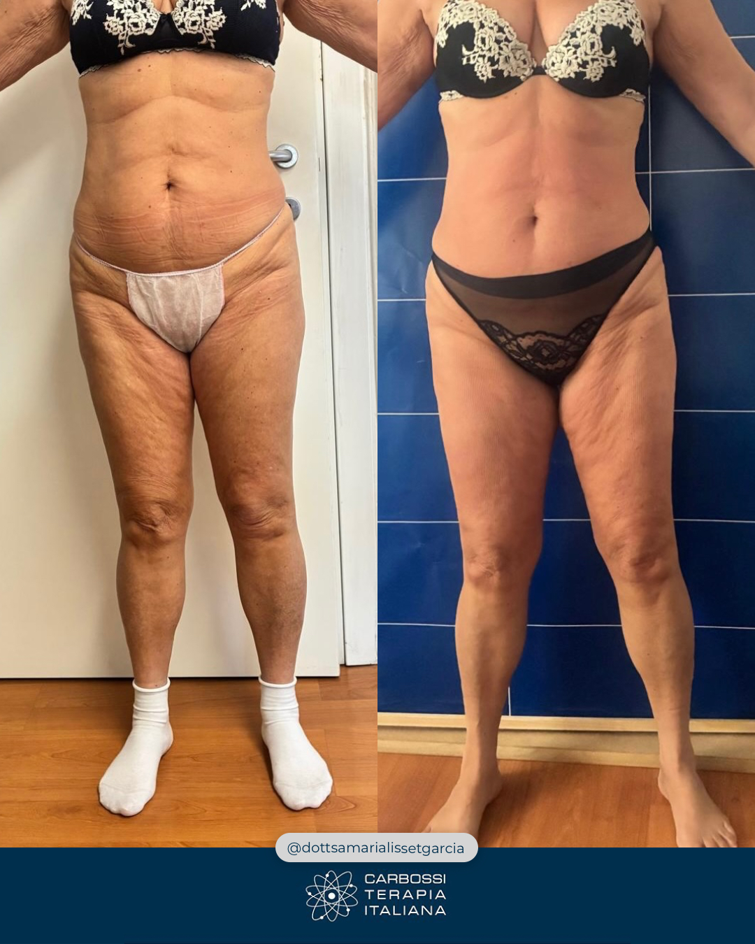 Un risultato visibile già dopo la prima seduta non è mai casuale.È il frutto di un protocollo costruito con competenza, visione e attenzione al dettaglio.Un sentito grazie alla dr.ssa @dottsamarialissetgarcia per aver scelto la Carbossiterapia CDT LIGHT per il suo studio e per l’eccellente lavoro svolto sulla sua paziente.In questo caso, l’approccio combinato con Lipocel, LPG Endermologie e Carbossiterapia ha avuto un obiettivo chiaro: lavorare in profondità sulla qualità del tessuto, non fermarsi all’aspetto superficiale.Agire su microcircolo, tono e struttura cutanea significa permettere al corpo di rispondere in modo più efficace… e i risultati si vedono già dalle prime sedute.Quello che vedete è un prima e dopo reale, senza filtri, dopo una sola seduta.Ma è fondamentale ricordarlo: il singolo trattamento è solo l’inizio.I risultati più solidi si costruiscono nel tempo, con protocolli personalizzati e continuità.Complimenti ancora per la professionalità e per aver dimostrato, ancora una volta, l’efficacia della Carbossiterapia CDT LIGHT — soprattutto quando integrata in protocolli sinergici.📍Via Cernaia, 24 – Torino📞392 4280412#carbossiterapia #cdtlight #medicinaestetica #lipocel #lpgendermologie #aestheticmedicine #risultatireali