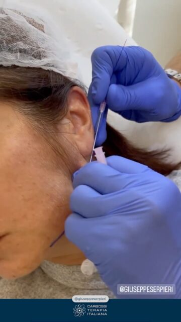 Un ringraziamento speciale al Dr. @giuseppeserpieri per aver scelto i fili SHAPING UP ed ELEVANCE di Carbossiterapia Italiana e per gli straordinari risultati ottenuti grazie alla sua tecnica esperta. ✨Il repositioning dei tessuti con fili PDO è una vera arte, fatta di precisione, esperienza e visione estetica.Siamo orgogliosi di vedere i nostri dispositivi valorizzati da professionisti che trasformano passione e competenza in risultati concreti per i pazienti.“Tissues repositioning with PDO Threads: that’s what I’m really passionate of.”Grazie Dottore per condividere ogni giorno eccellenza, formazione e innovazione. 🙌#CarbossiterapiaItaliana #ShapingUp #Elevance #PDOThreads #ThreadLifting #AestheticMedicine #MedicinaEstetica #TissueRepositioning #BeautyInnovation